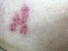 Herpes zoster