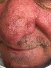 Rosacea