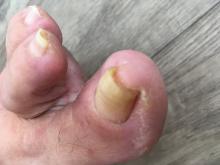 Tinea