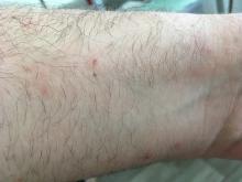 Scabies