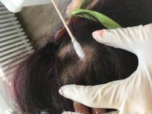Alopecia areata