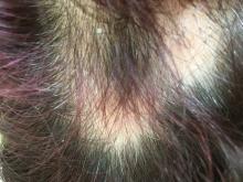 Alopecia areata