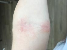 Eczema atopicum