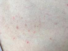 Scabies
