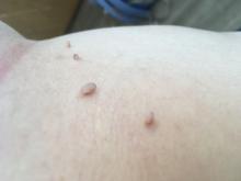 Fibromy