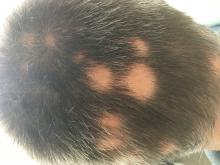 Alopecia areata