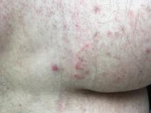 Tinea