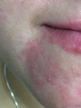 Dermatitis perioralis