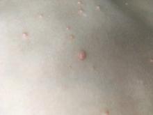 Mollusca contagiosa