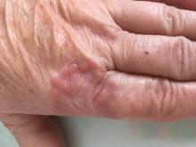 Granuloma annulare