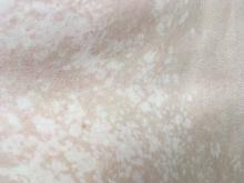 Pityriasis versicolor