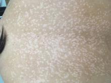Pityriasis versicolor