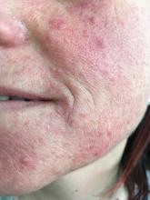 Dermatitis perioralis
