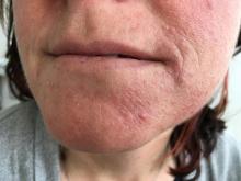 Dermatitis perioralis