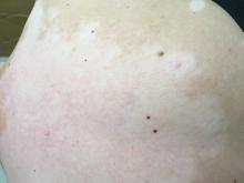Vitiligo