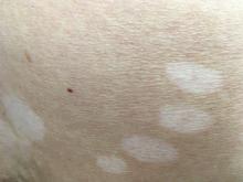 Vitiligo