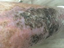 Eczema microbiale