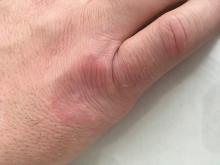 Granuloma annulare